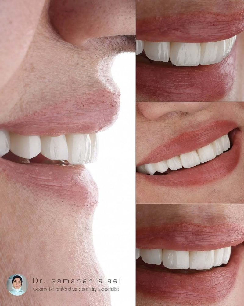 لمینیت سرامیکی دندان در اصفهان دکتر سمانه علایی متخصص دندانپزشکی ترمیمی و زیبایی
