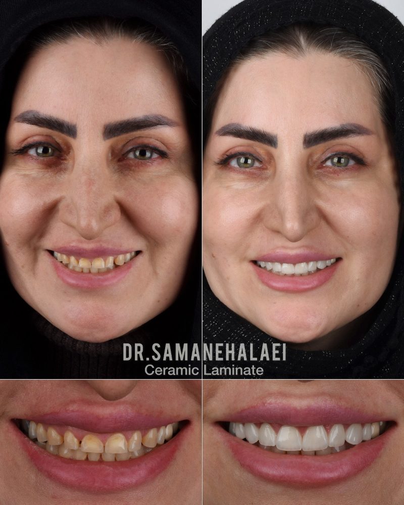 نمونه درمان لمینیت سرامیکی دکتر سمانه علایی در اصفهان